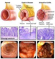 Crohn's Disease